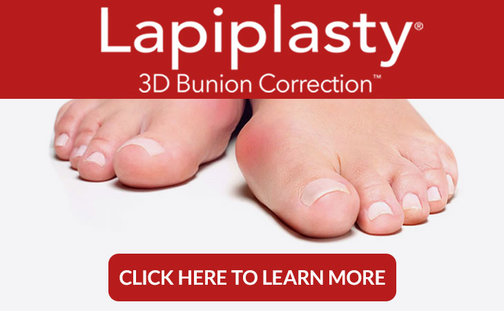 lapiplasty