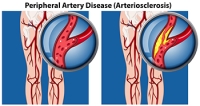 Using Ultrasound to Diagnose Peripheral Artery Disease