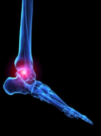 Psoriatic Arthritis Can Affect the Feet