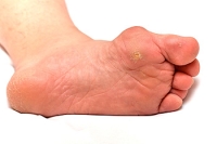 How Do I Know If I Have A Bunion?