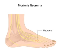 Painful Morton’s Neuroma