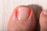 What Should I Do for My Ingrown Toenail?