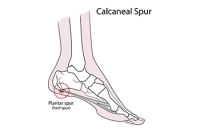 Minimally Invasive Surgery for Heel Spurs
