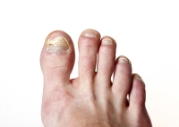 Why Is My Toenail Discolored?