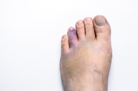 Symptoms and Long-Term Implications of a Broken Toe