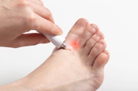 Athlete’s Foot Infections